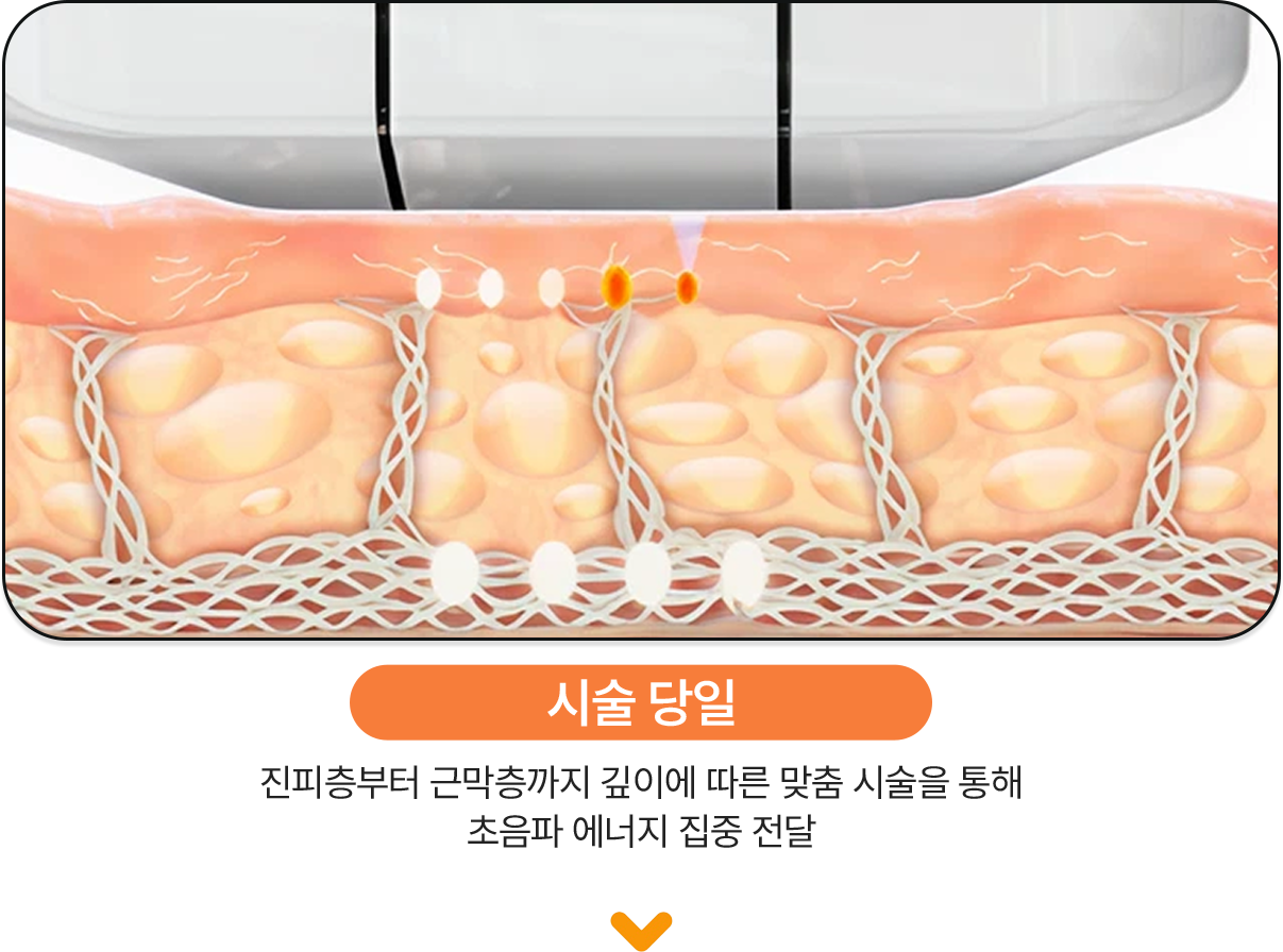 시술당일